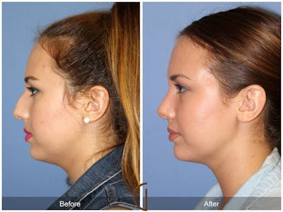 Female Rhinoplasty Before & After Gallery - Patient 328110 - Image 1