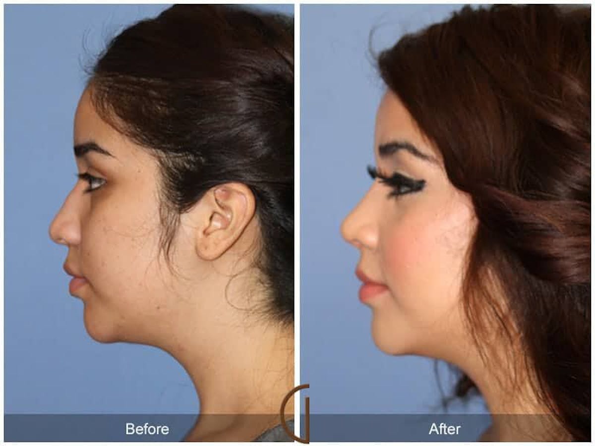 Ethnic Rhinoplasty Before & After Gallery - Patient 682638 - Image 1