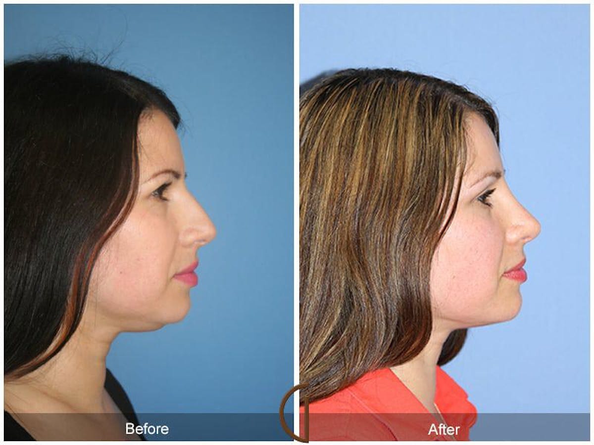Revision Rhinoplasty Before & After Gallery - Patient 340724 - Image 3