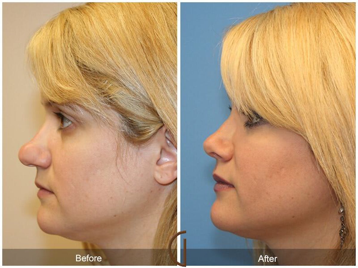 Female Rhinoplasty Before & After Gallery - Patient 425316 - Image 1