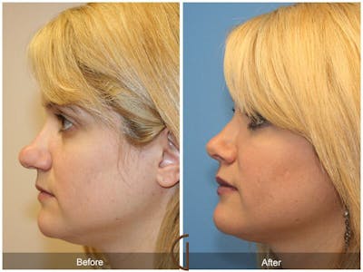 Female Rhinoplasty Before & After Gallery - Patient 425316 - Image 1