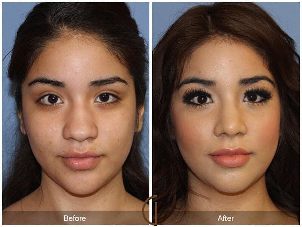 Ethnic Rhinoplasty Before & After Gallery - Patient 682638 - Image 2