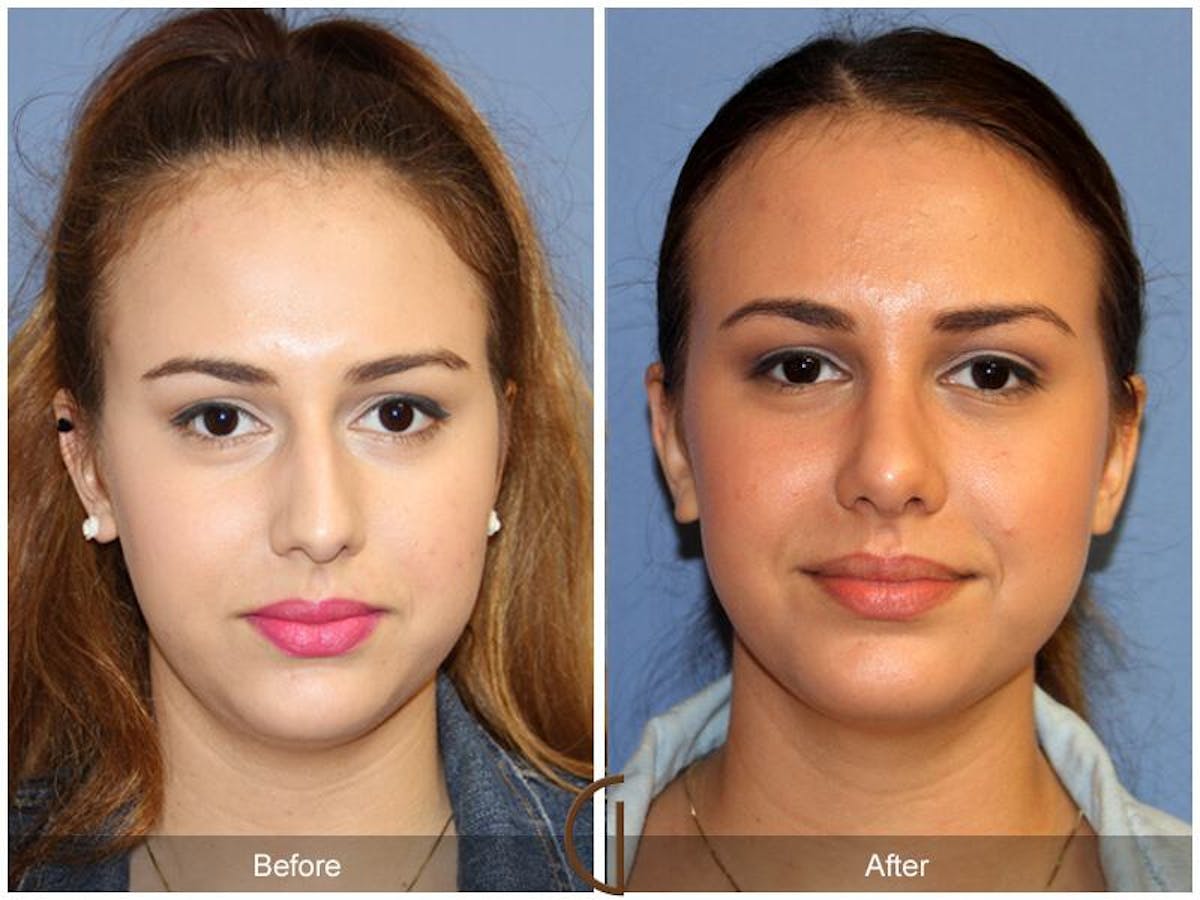 Female Rhinoplasty Before & After Gallery - Patient 328110 - Image 2