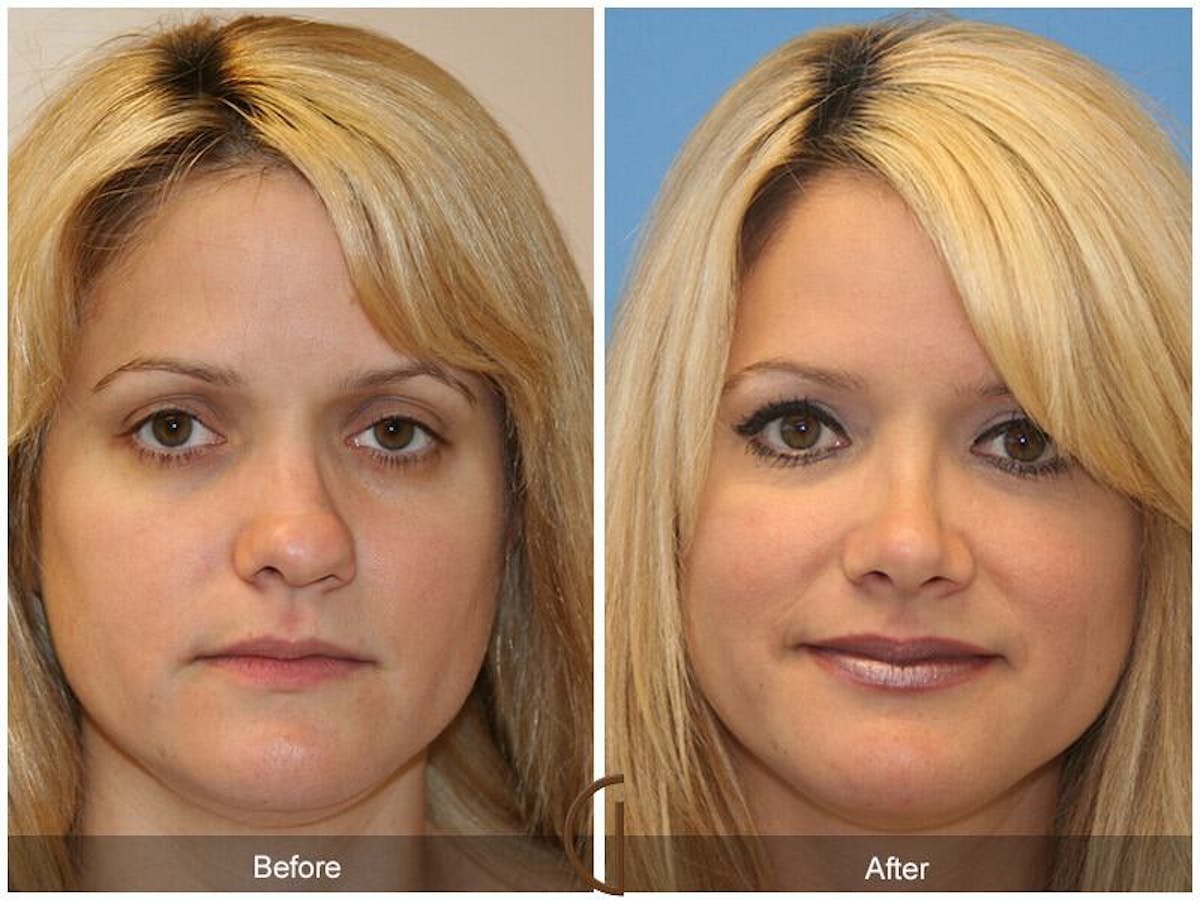 Female Rhinoplasty Before & After Gallery - Patient 425316 - Image 2