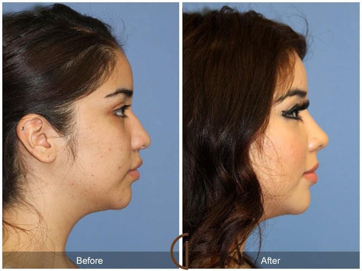 Ethnic Rhinoplasty Before & After Gallery - Patient 682638 - Image 3