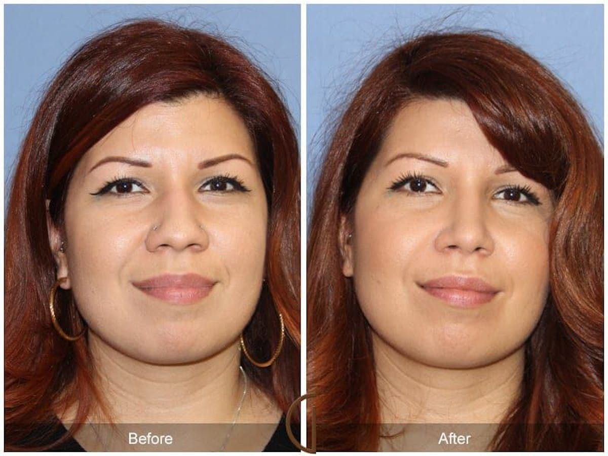 Ethnic Rhinoplasty Before & After Gallery - Patient 177188 - Image 2