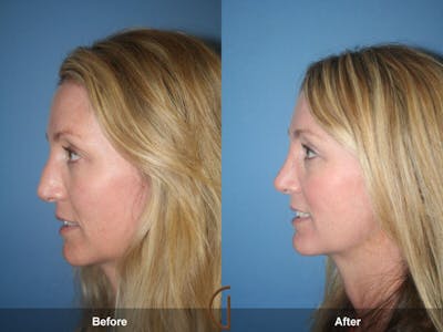 Female Rhinoplasty Before & After Gallery - Patient 157867 - Image 1