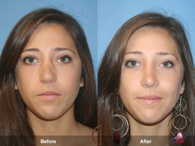 Revision Rhinoplasty Before & After Gallery - Patient 358602 - Image 1