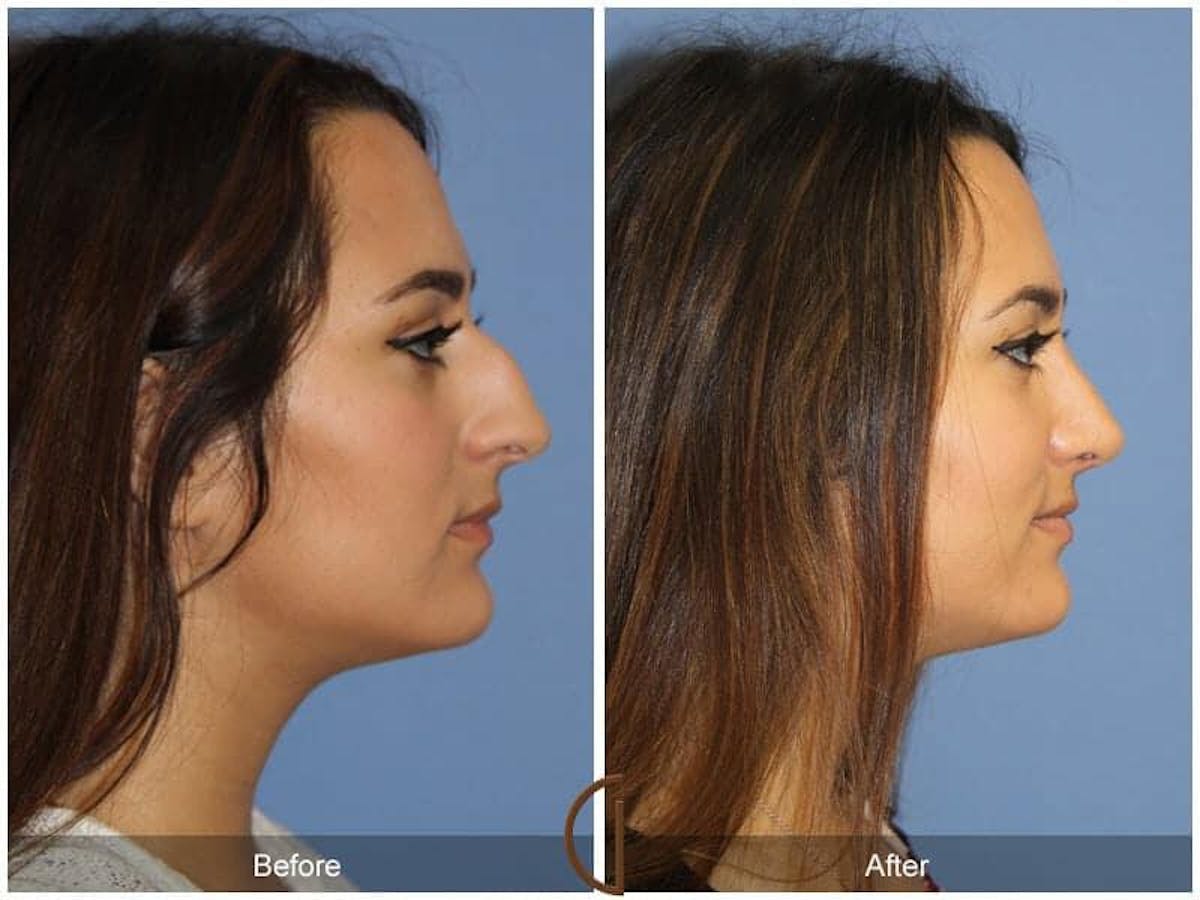 Ethnic Rhinoplasty Before & After Gallery - Patient 207509 - Image 3