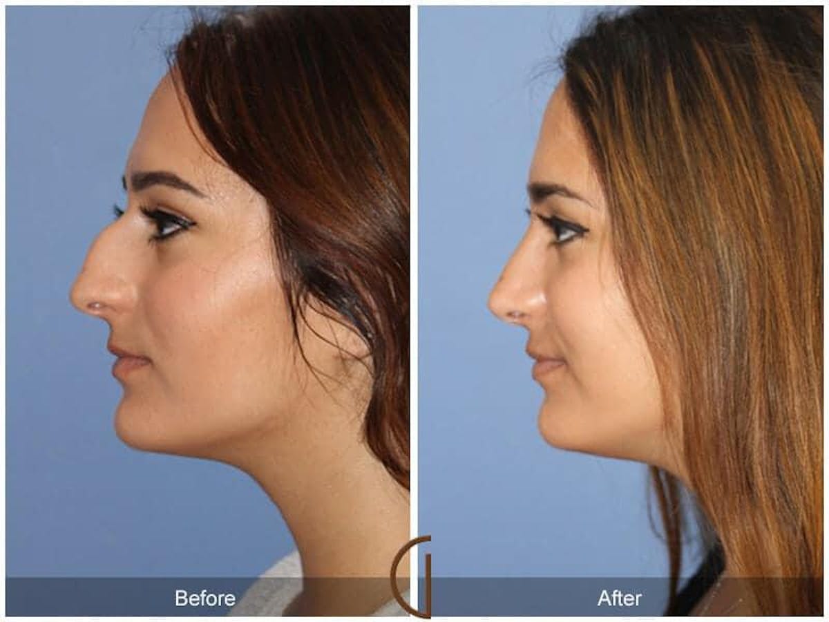 Ethnic Rhinoplasty Before & After Gallery - Patient 207509 - Image 1