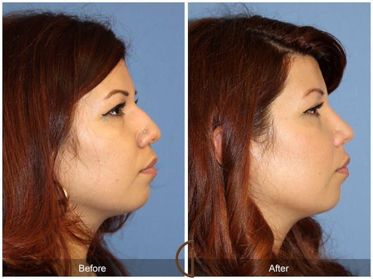 Ethnic Rhinoplasty Before & After Gallery - Patient 177188 - Image 3