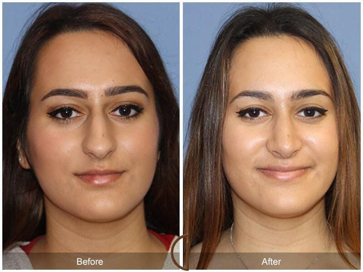 Ethnic Rhinoplasty Before & After Gallery - Patient 207509 - Image 2