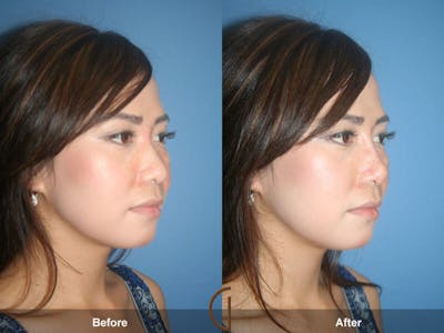 Female Rhinoplasty Before & After Gallery - Patient 115491 - Image 1