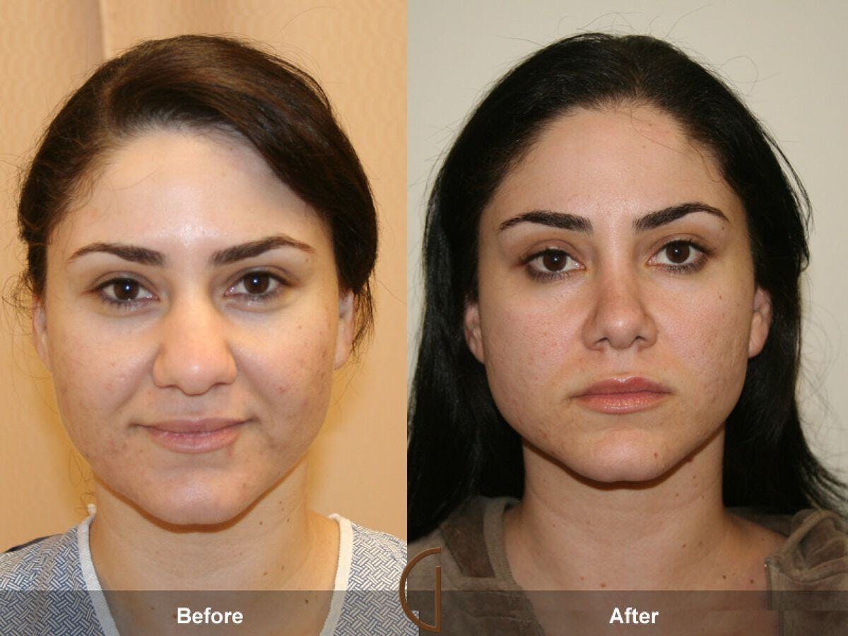 Rhinoplasty Before & After Gallery - Patient 216445 - Image 1
