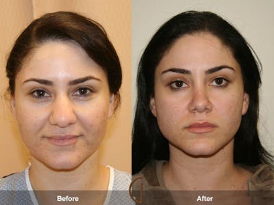 Rhinoplasty Before & After Gallery - Patient 216445 - Image 1