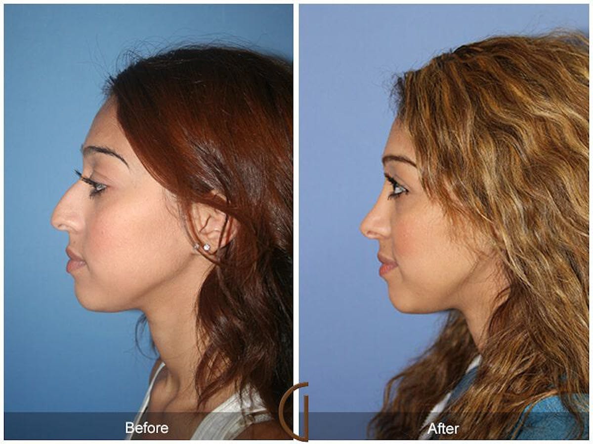 Ethnic Rhinoplasty Before & After Gallery - Patient 803252 - Image 1