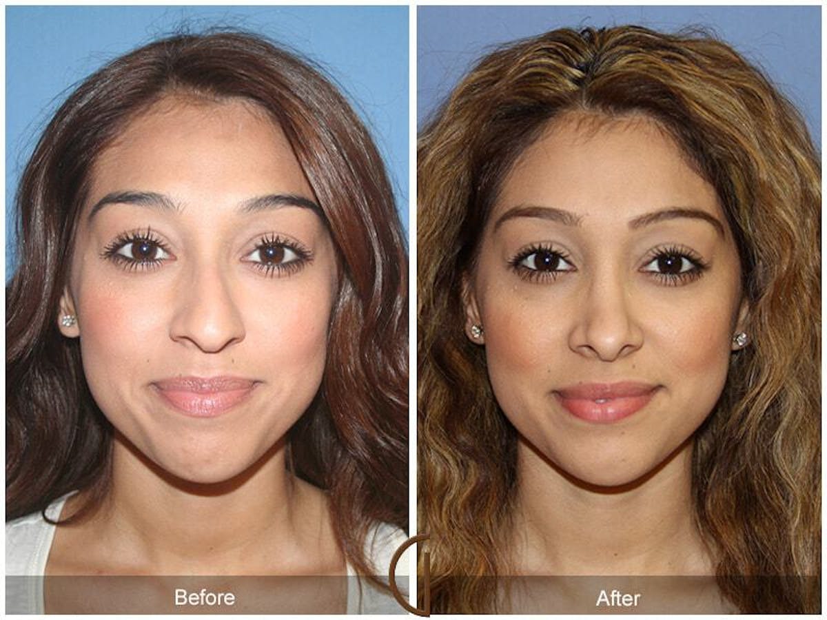 Ethnic Rhinoplasty Before & After Gallery - Patient 803252 - Image 2
