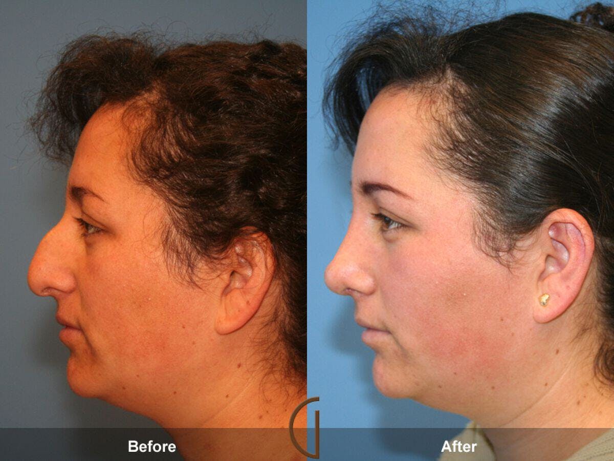 Female Rhinoplasty Before & After Gallery - Patient 109445 - Image 1