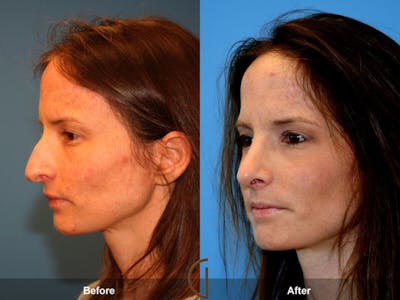 Revision Rhinoplasty Before & After Gallery - Patient 329414 - Image 1