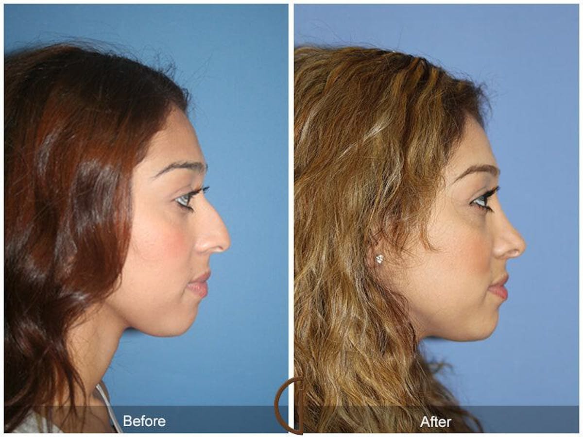 Ethnic Rhinoplasty Before & After Gallery - Patient 803252 - Image 3