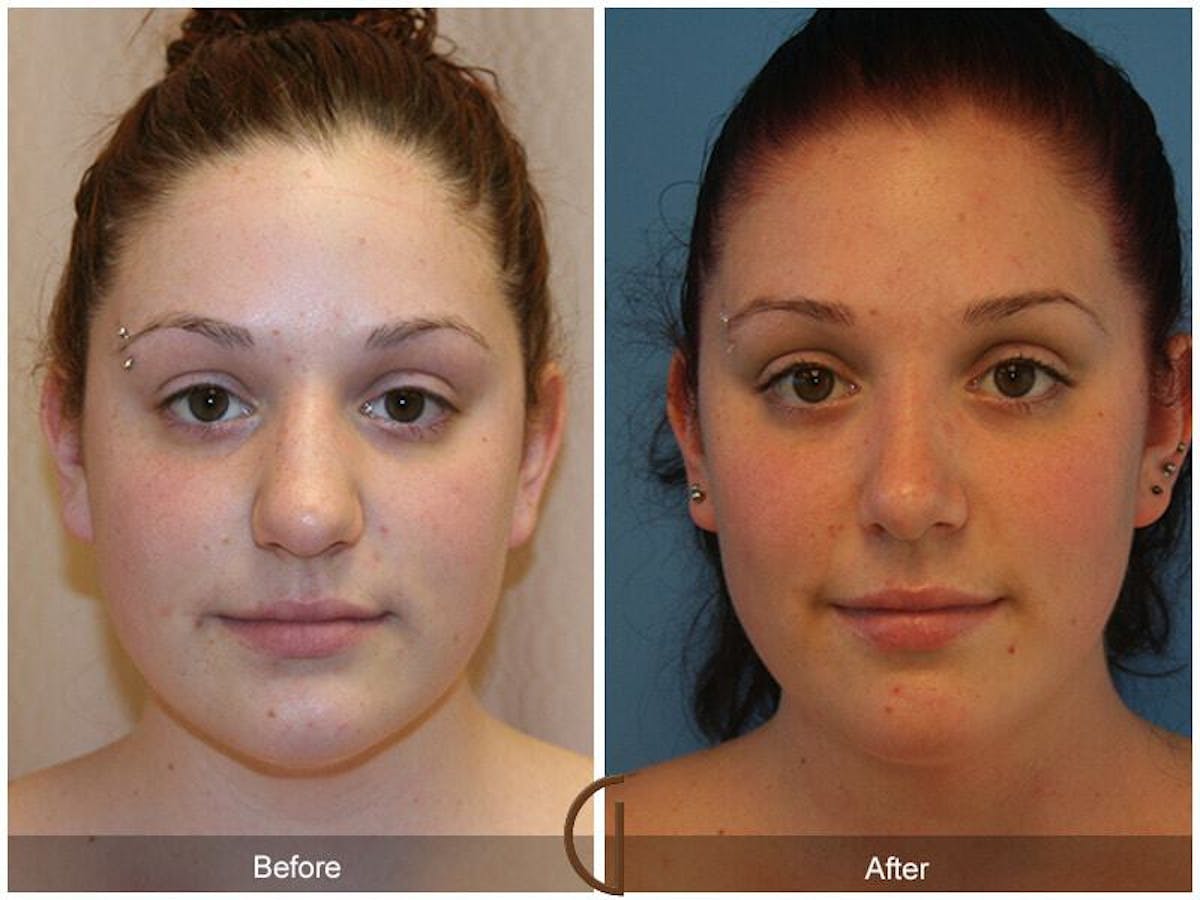 Female Rhinoplasty Before & After Gallery - Patient 968954 - Image 1