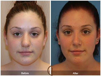 Female Rhinoplasty Before & After Gallery - Patient 968954 - Image 1