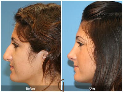 Female Rhinoplasty Before & After Gallery - Patient 243391 - Image 1