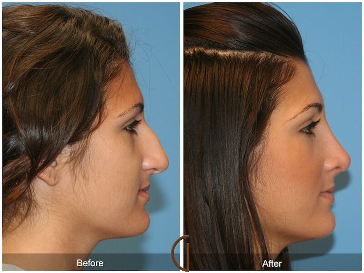 Female Rhinoplasty Before & After Gallery - Patient 243391 - Image 2