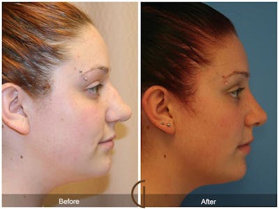 Rhinoplasty Before & After Gallery - Patient 360942 - Image 1