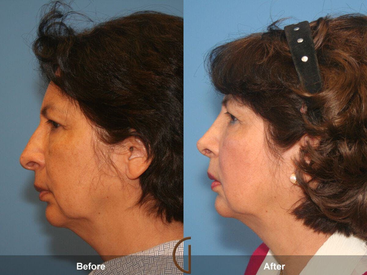 Rhinoplasty Before & After Gallery - Patient 319749 - Image 1