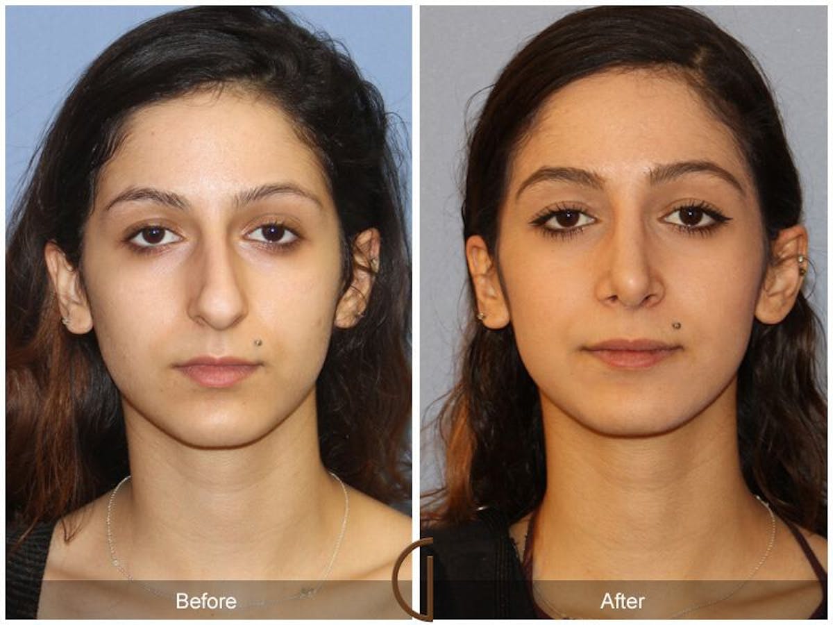 Female Rhinoplasty Before & After Gallery - Patient 324603 - Image 2