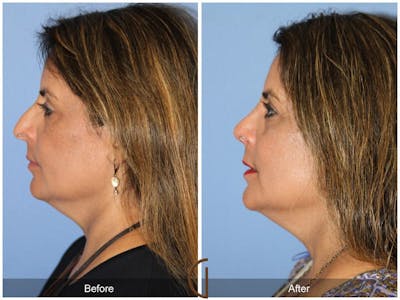 Rhinoplasty Before & After Gallery - Patient 156077 - Image 1