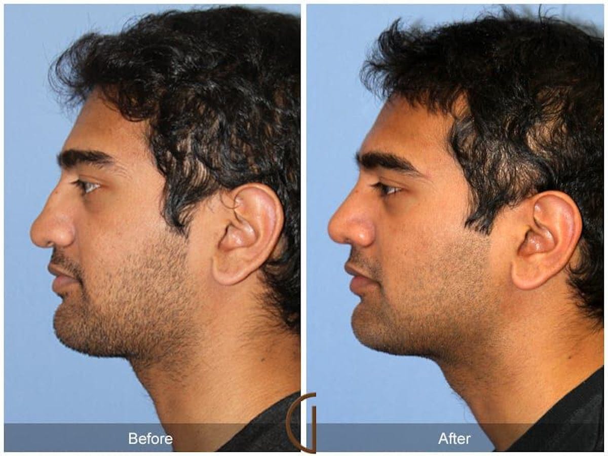 Male Rhinoplasty Before & After Gallery - Patient 115995 - Image 1