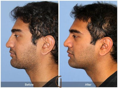Male Rhinoplasty Before & After Gallery - Patient 115995 - Image 1