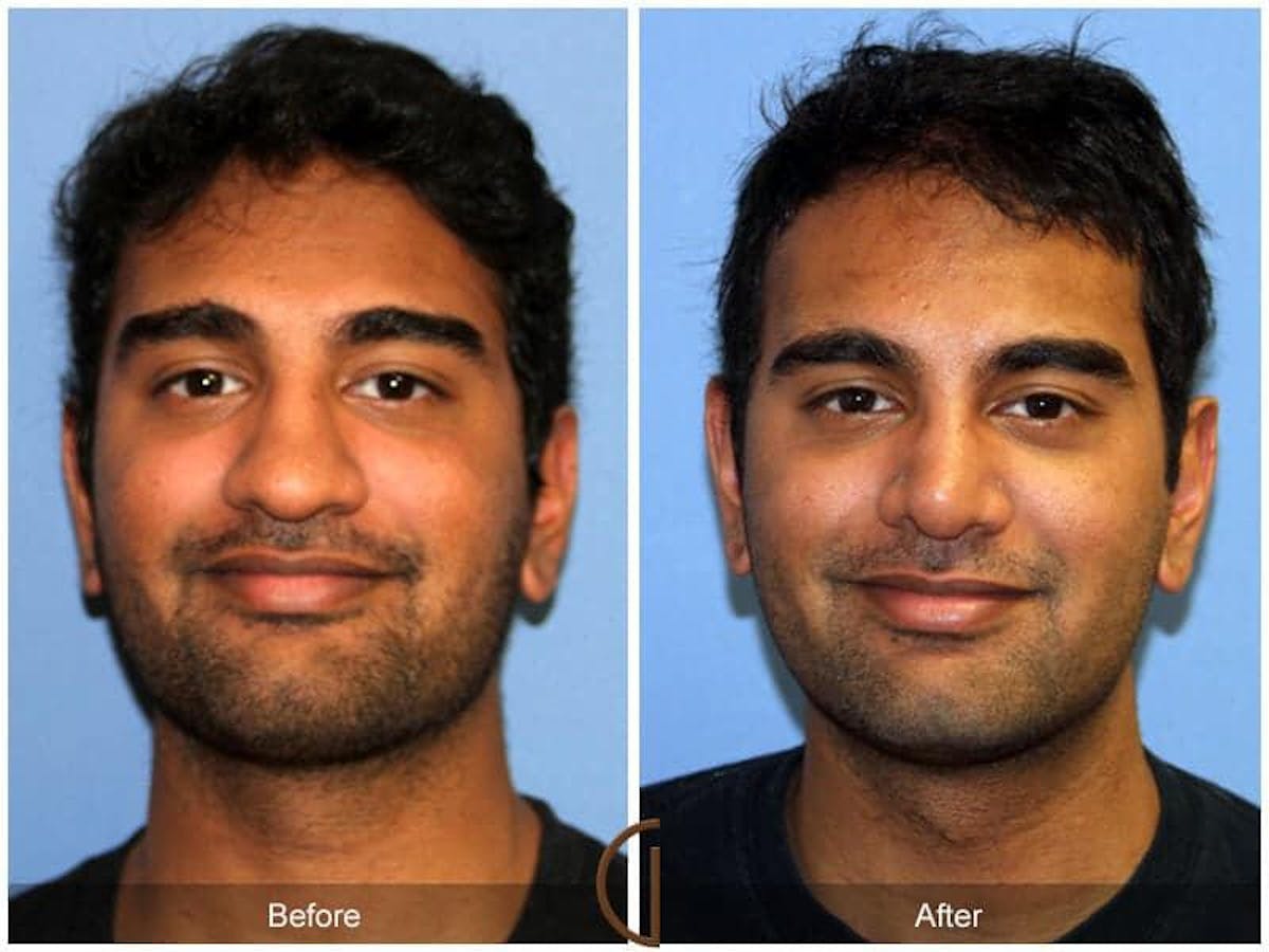 Male Rhinoplasty Before & After Gallery - Patient 115995 - Image 2