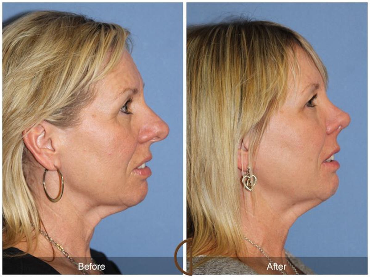 Female Rhinoplasty Before & After Gallery - Patient 175408 - Image 3