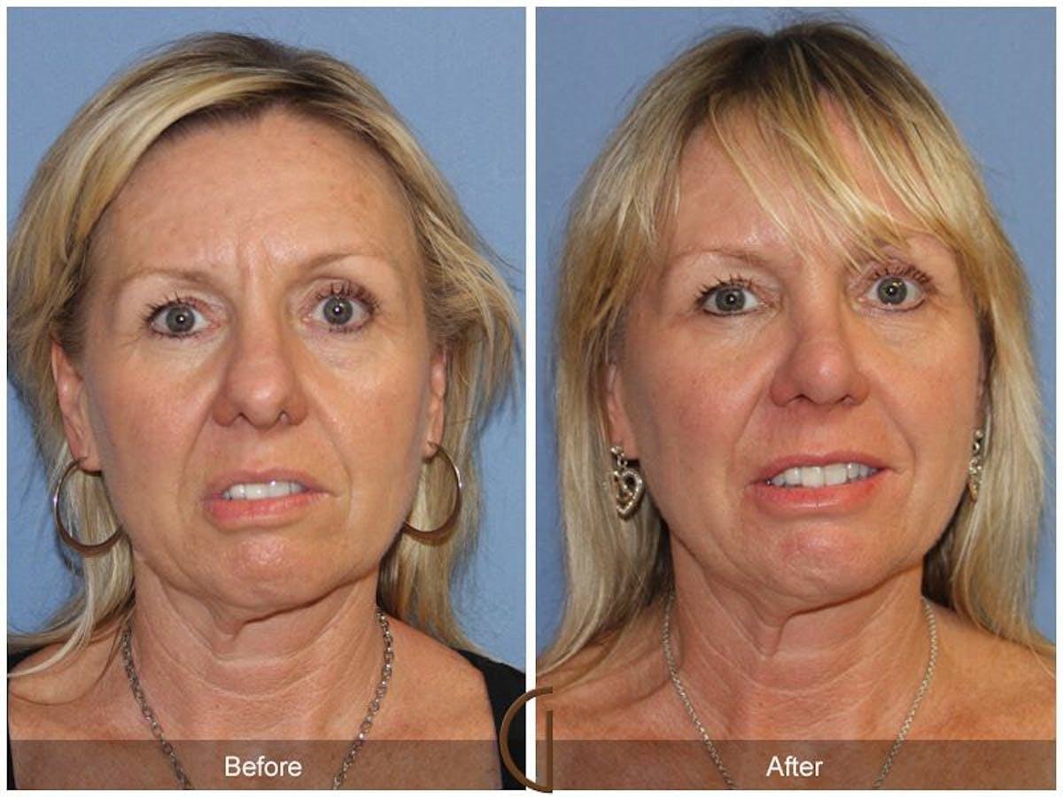 Female Rhinoplasty Before & After Gallery - Patient 175408 - Image 2