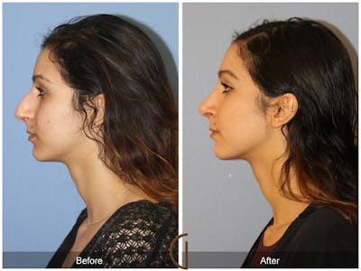 Female Rhinoplasty Before & After Gallery - Patient 324603 - Image 1