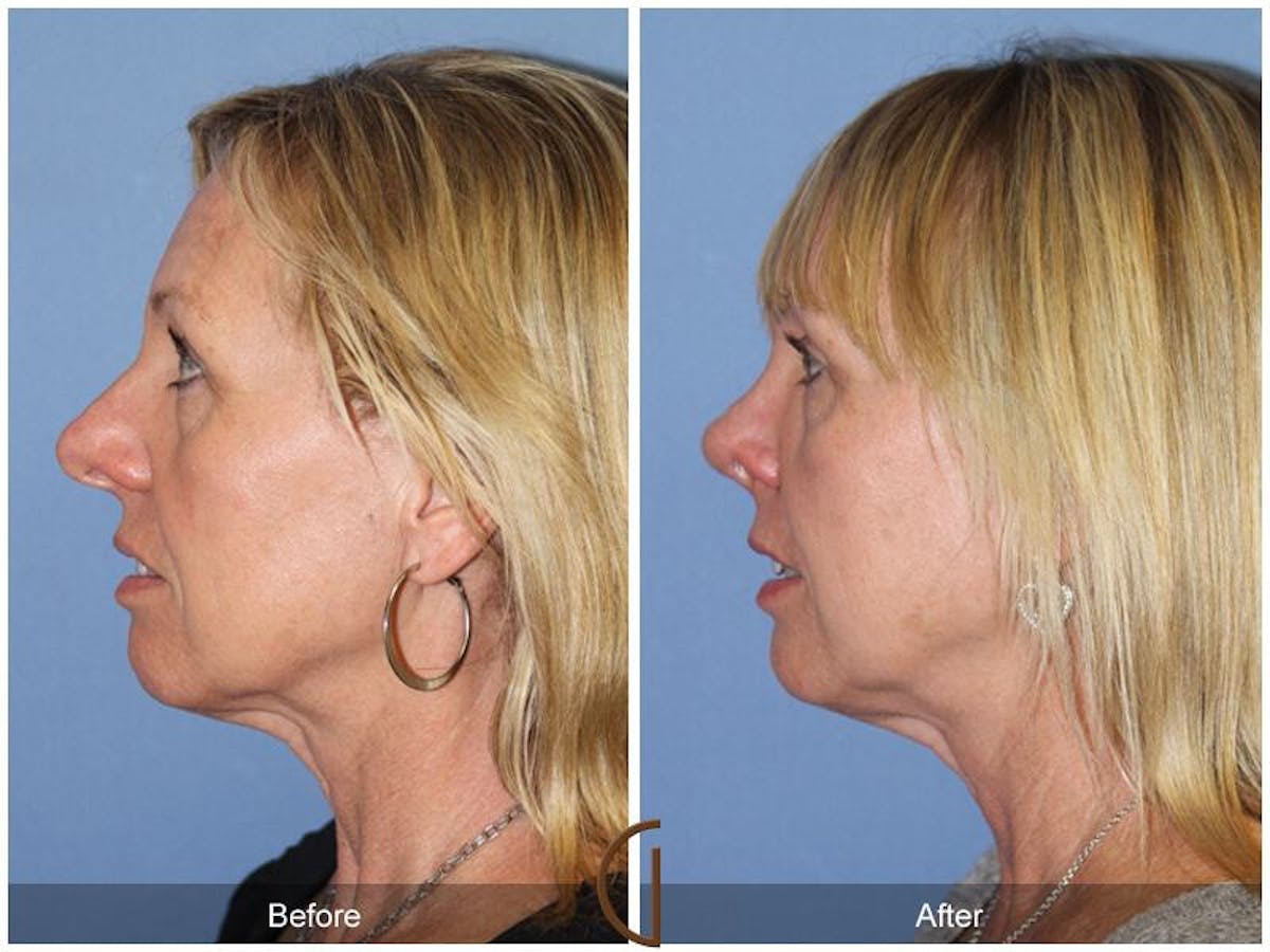 Female Rhinoplasty Before & After Gallery - Patient 175408 - Image 1
