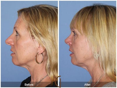 Female Rhinoplasty Before & After Gallery - Patient 175408 - Image 1