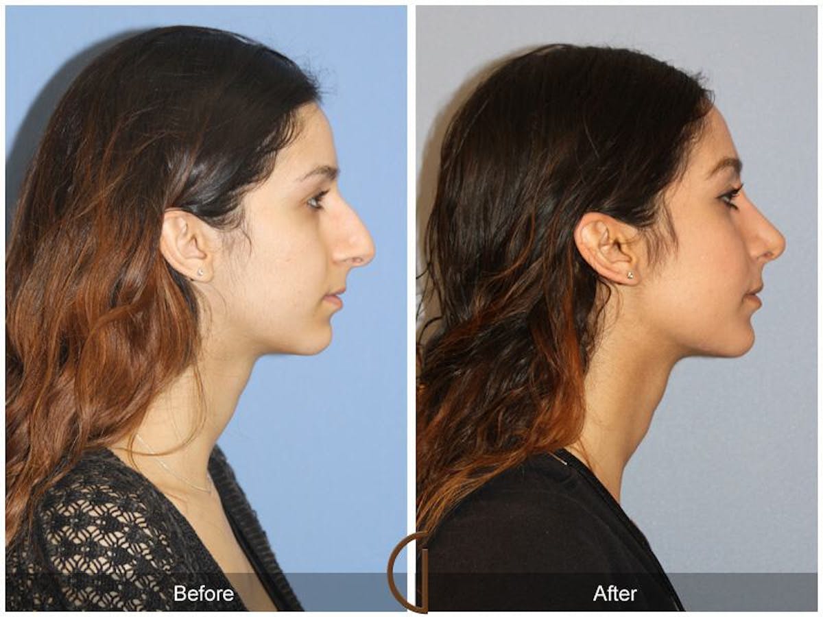 Female Rhinoplasty Before & After Gallery - Patient 324603 - Image 3