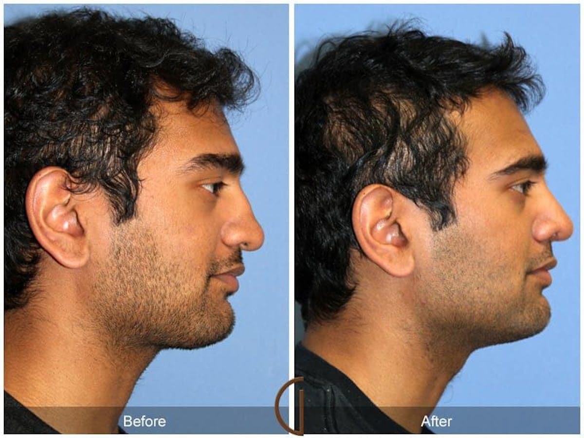 Male Rhinoplasty Before & After Gallery - Patient 115995 - Image 3