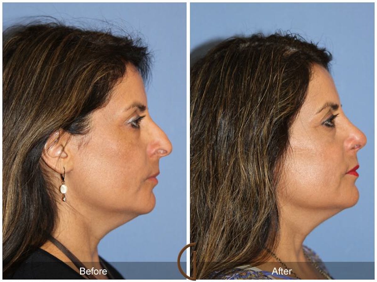 Rhinoplasty Before & After Gallery - Patient 156077 - Image 3