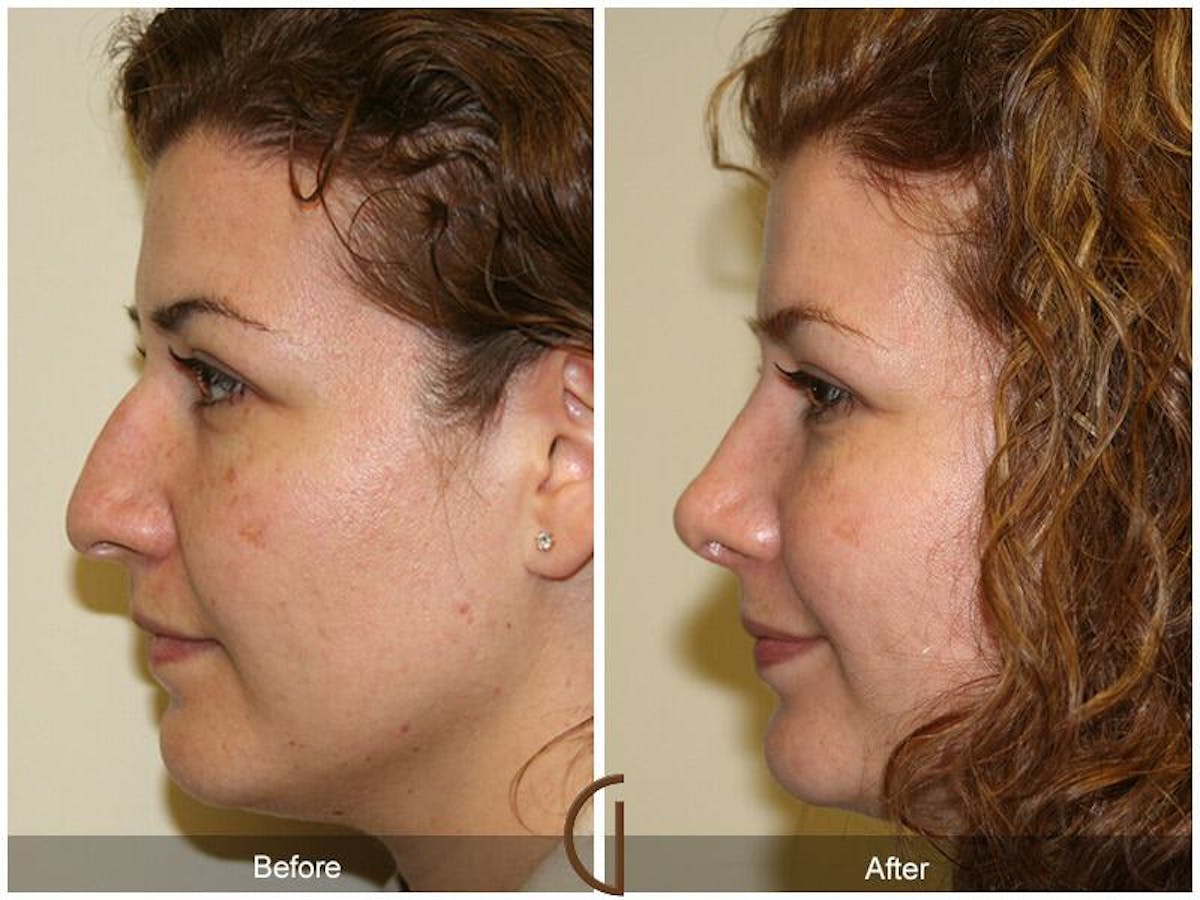 Female Rhinoplasty Before & After Gallery - Patient 283123 - Image 1