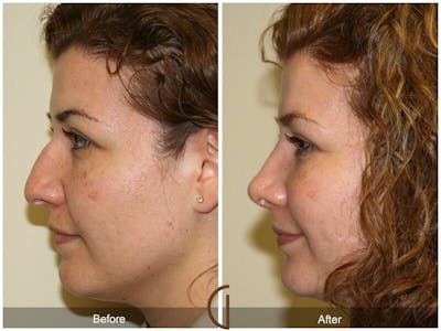 Female Rhinoplasty Before & After Gallery - Patient 283123 - Image 1
