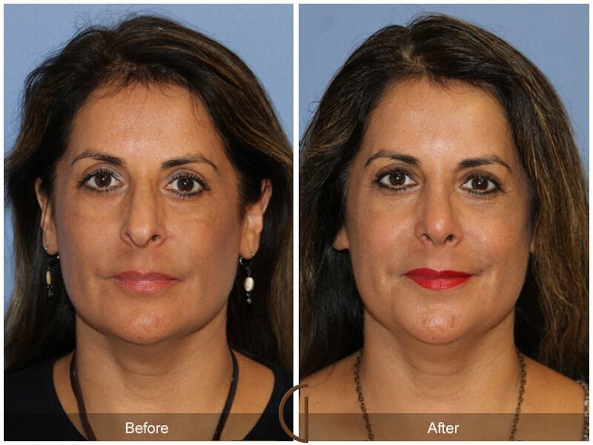 Rhinoplasty Before & After Gallery - Patient 156077 - Image 2