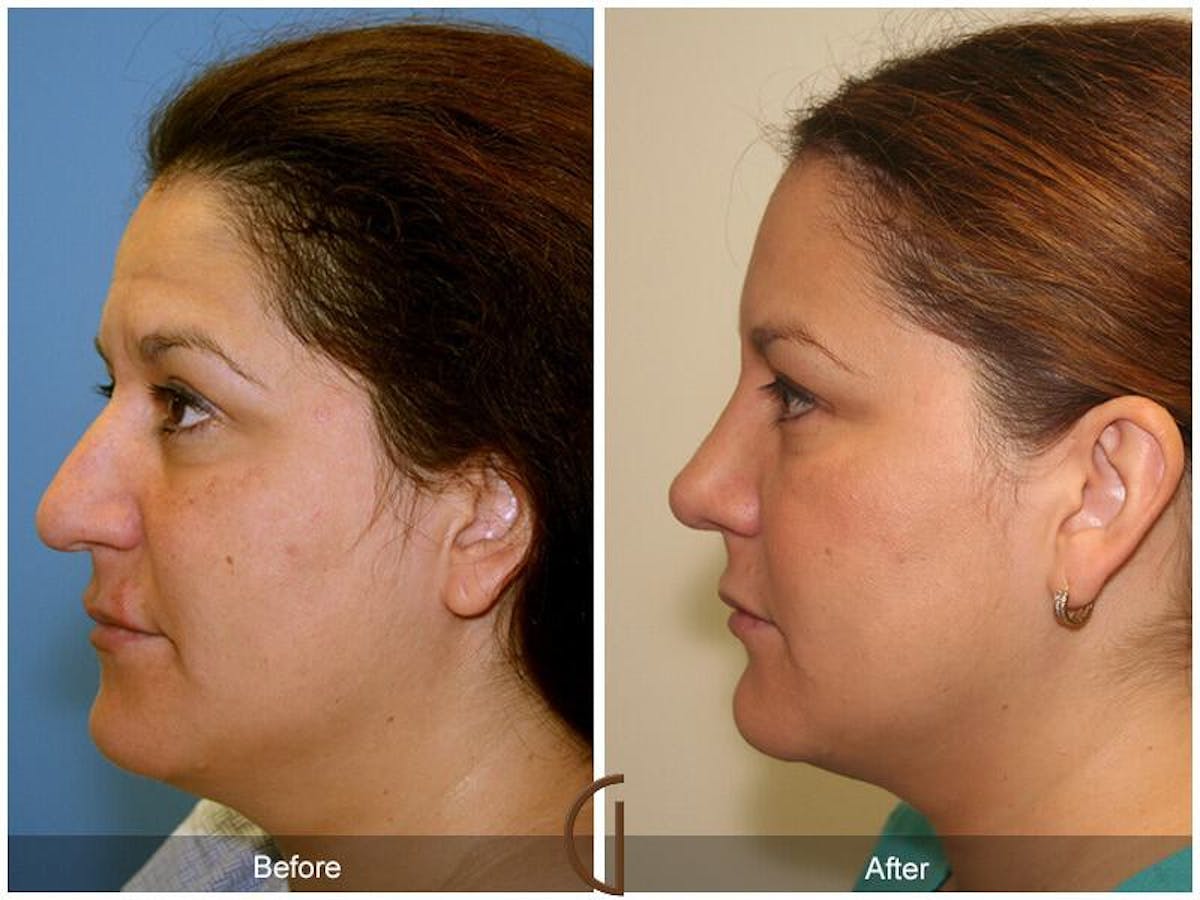 Female Rhinoplasty Before & After Gallery - Patient 170072 - Image 1