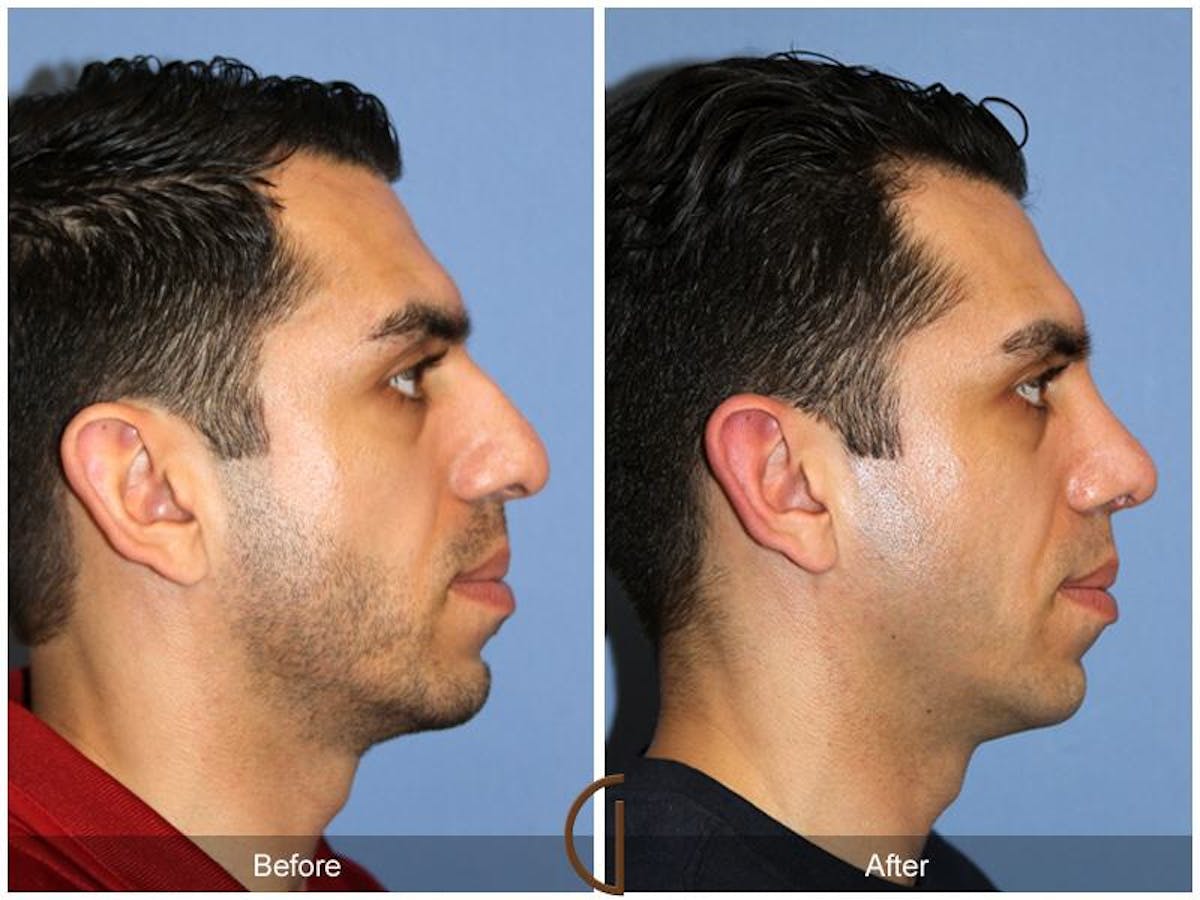 Male Rhinoplasty Before & After Gallery - Patient 220223 - Image 3