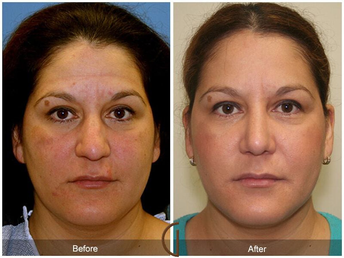 Female Rhinoplasty Before & After Gallery - Patient 170072 - Image 2