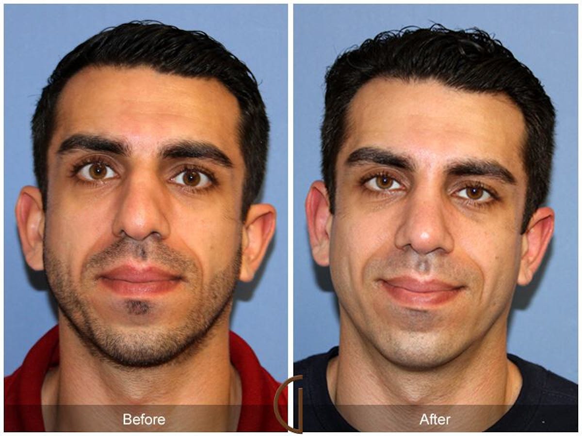 Male Rhinoplasty Before & After Gallery - Patient 220223 - Image 2